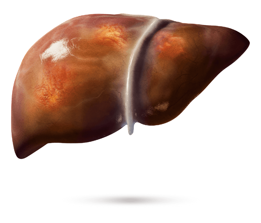 Medizinische Illustration einer Leber mit sichtbarer Fibrose.