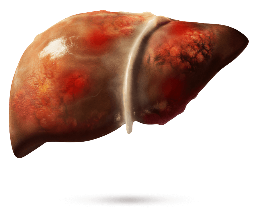 Medizinische Illustration einer Leber mit sichtbarer Fibrose.