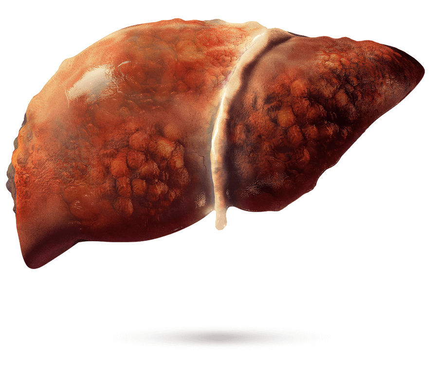 Medizinische Illustration einer Leber mit sichtbarer Fibrose.