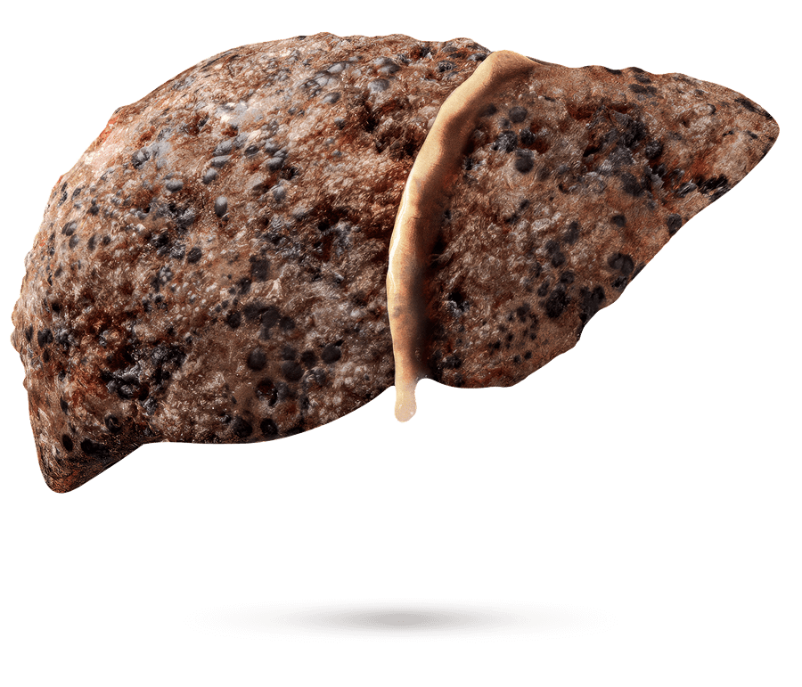 Medizinische Illustration einer Leber mit sichtbarer Fibrose.